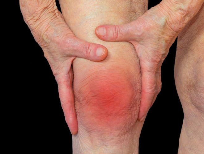 Artritis-Todo-Lo-Que-Necesitas-Saber-oh-my-boomer